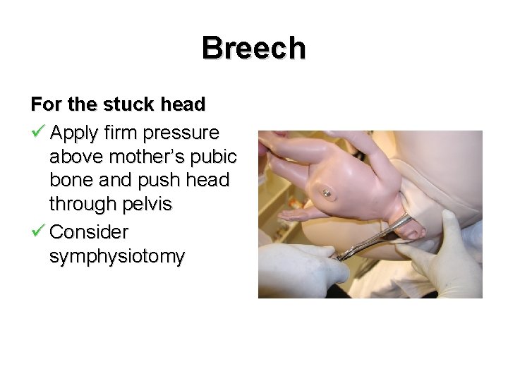 Breech For the stuck head ü Apply firm pressure above mother’s pubic bone and