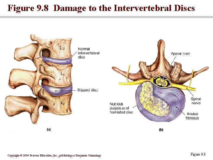 Figure 9. 8 Damage to the Intervertebral Discs Copyright © 2004 Pearson Education, Inc.