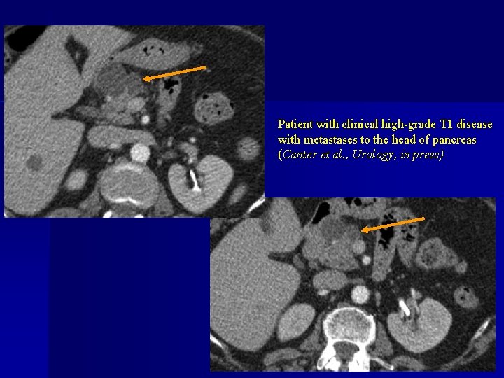 Patient with clinical high-grade T 1 disease with metastases to the head of pancreas