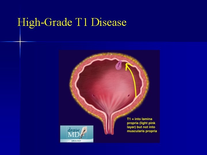 High-Grade T 1 Disease 