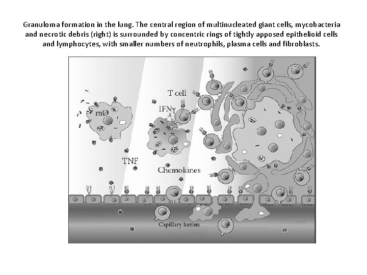 Granuloma formation in the lung. The central region of multinucleated giant cells, mycobacteria and