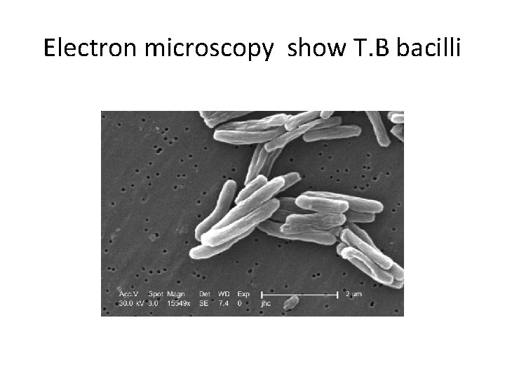 Electron microscopy show T. B bacilli 