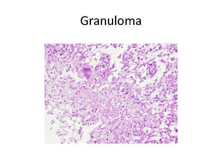 Granuloma 
