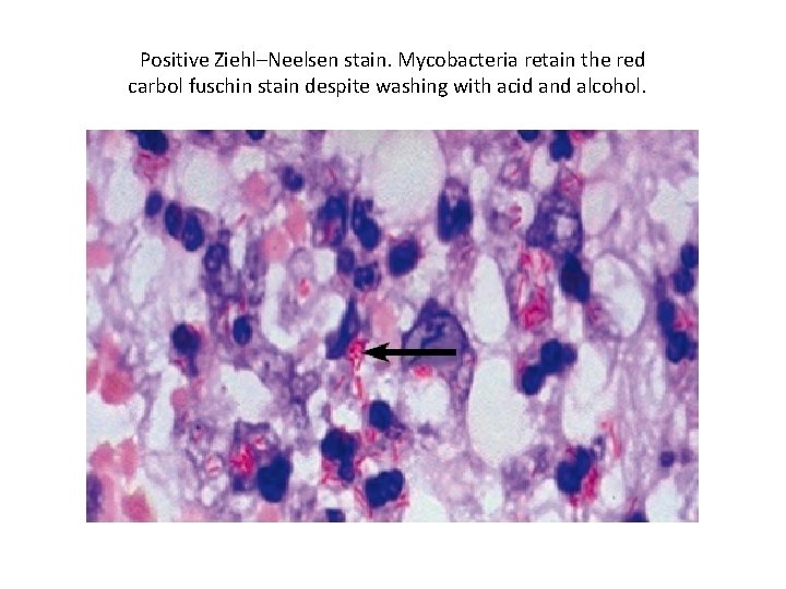 Positive Ziehl–Neelsen stain. Mycobacteria retain the red carbol fuschin stain despite washing with acid