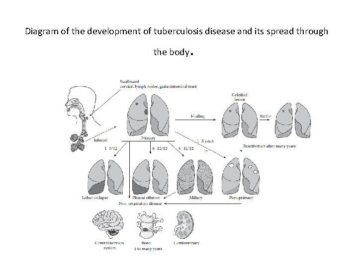 Diagram of the development of tuberculosis disease and its spread through the body .