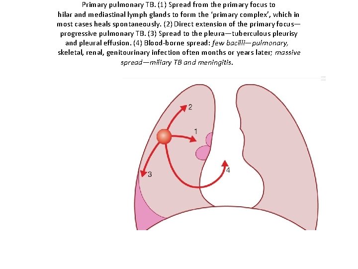 Primary pulmonary TB. (1) Spread from the primary focus to hilar and mediastinal lymph