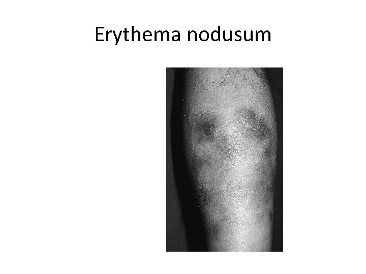 Erythema nodusum 