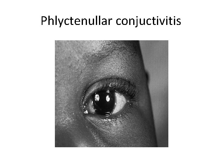 Phlyctenullar conjuctivitis 