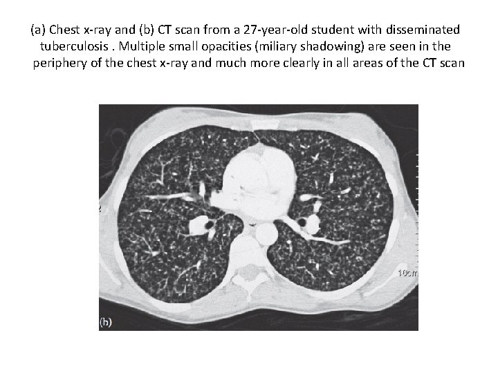 (a) Chest x-ray and (b) CT scan from a 27 -year-old student with disseminated