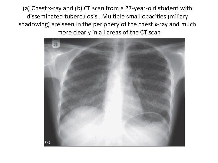(a) Chest x-ray and (b) CT scan from a 27 -year-old student with disseminated