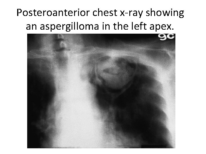 Posteroanterior chest x-ray showing an aspergilloma in the left apex. 