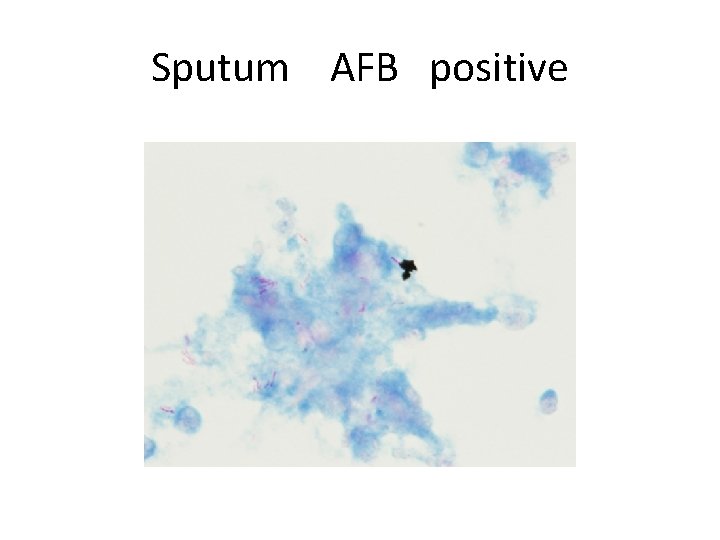 Sputum AFB positive 