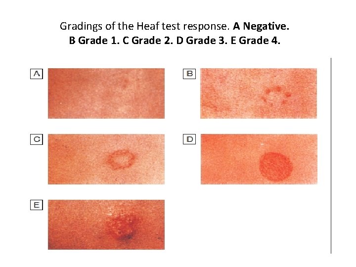 Gradings of the Heaf test response. A Negative. B Grade 1. C Grade 2.