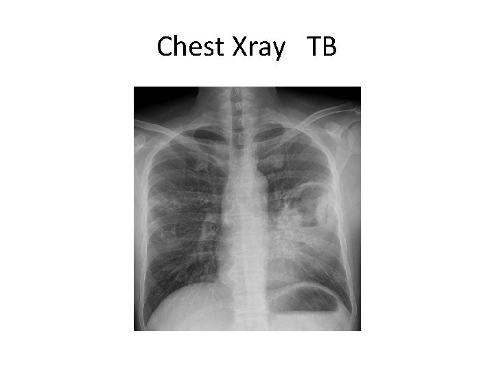 Chest Xray TB 