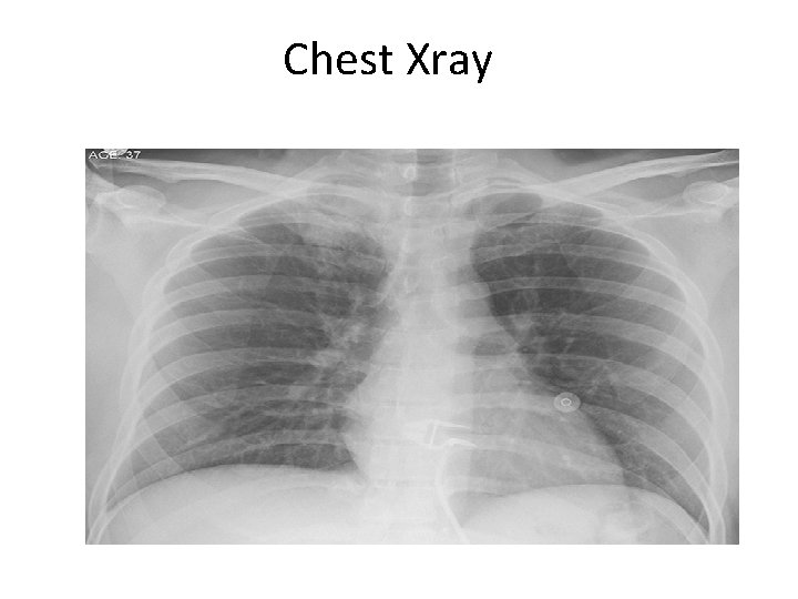 Chest Xray 