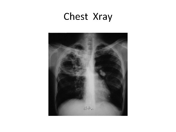 Chest Xray 