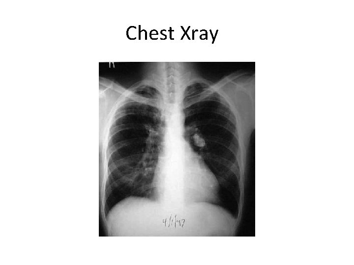 Chest Xray 