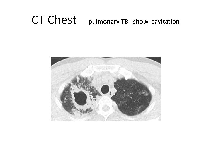 CT Chest pulmonary TB show cavitation 