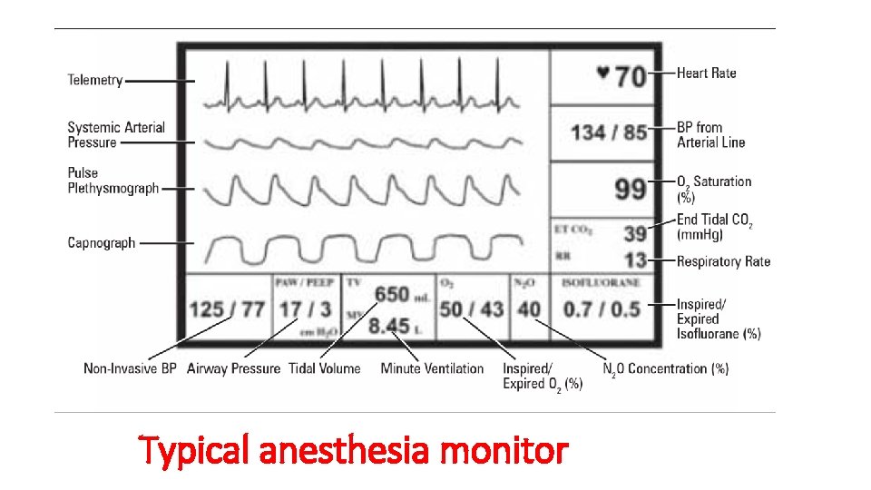 Typical anesthesia monitor 