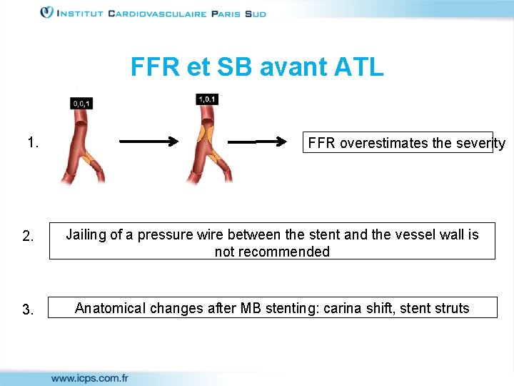 FFR et SB avant ATL 1. FFR overestimates the severity 2. Jailing of a