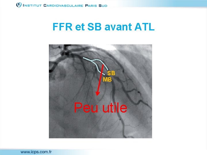 FFR et SB avant ATL SB MB Peu utile 