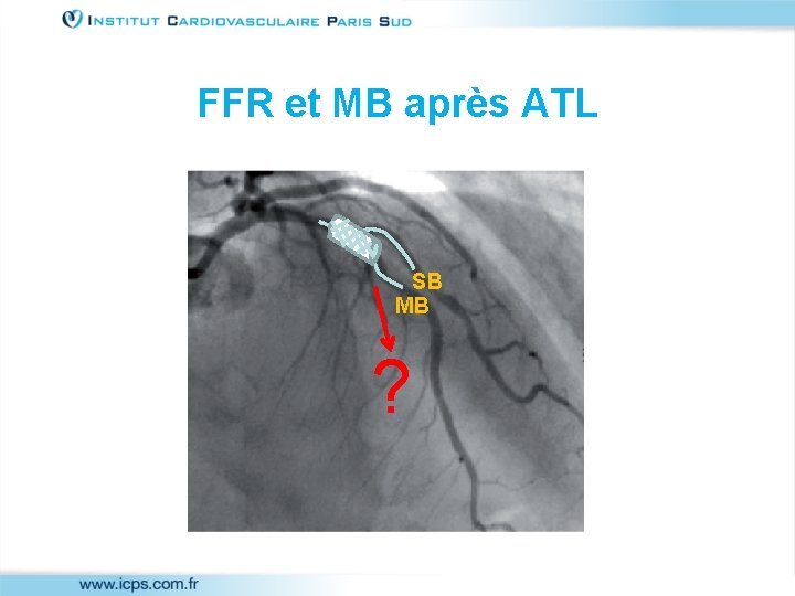 FFR et MB après ATL SB MB ? 