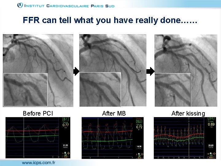 FFR can tell what you have really done…… Before PCI After MB stenting After