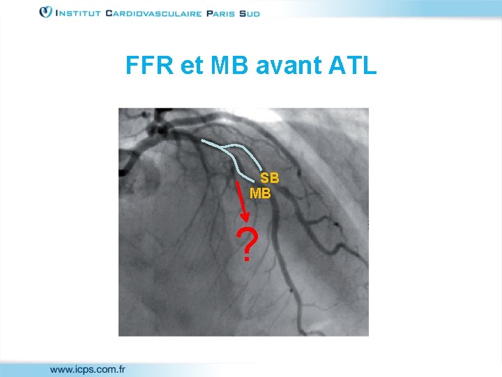 FFR et MB avant ATL SB MB ? 