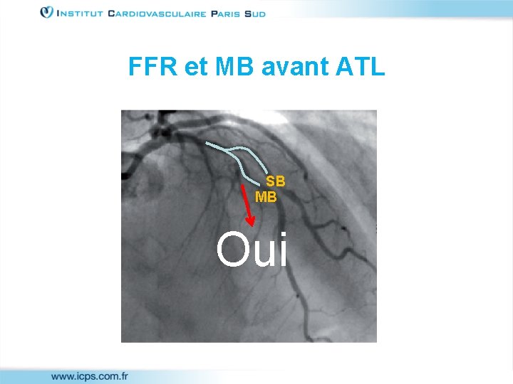 FFR et MB avant ATL SB MB Oui 
