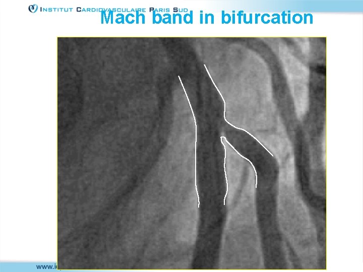 Mach band in bifurcation 