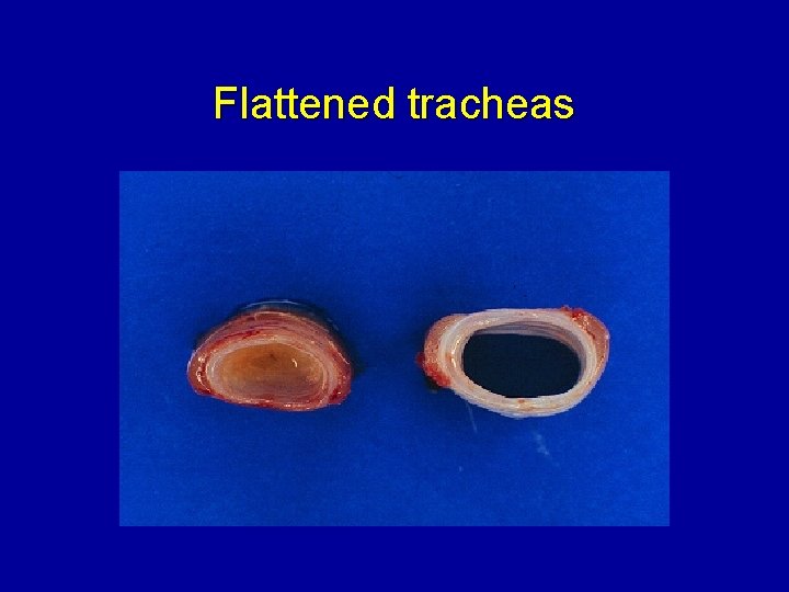 Flattened tracheas 