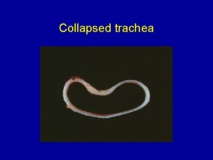 Collapsed trachea 