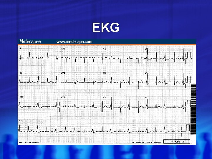 EKG 