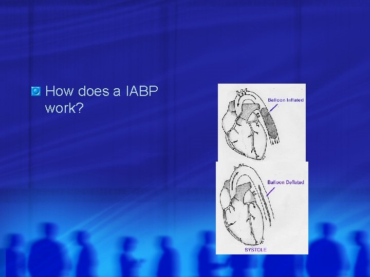 How does a IABP work? 