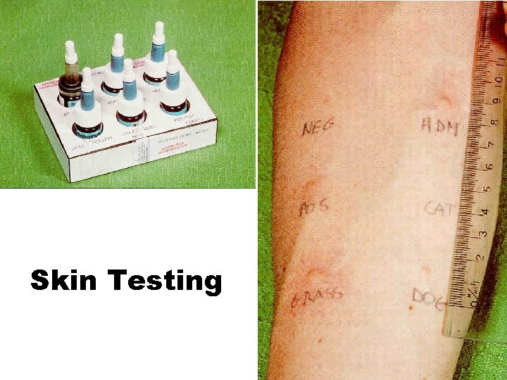 Skin Testing 