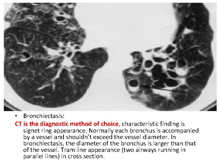  • Bronchiectasis: CT is the diagnostic method of choice, characteristic finding is signet