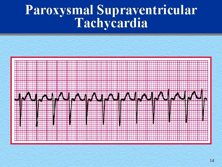 Paroxysmal Supraventricular Tachycardia 14 