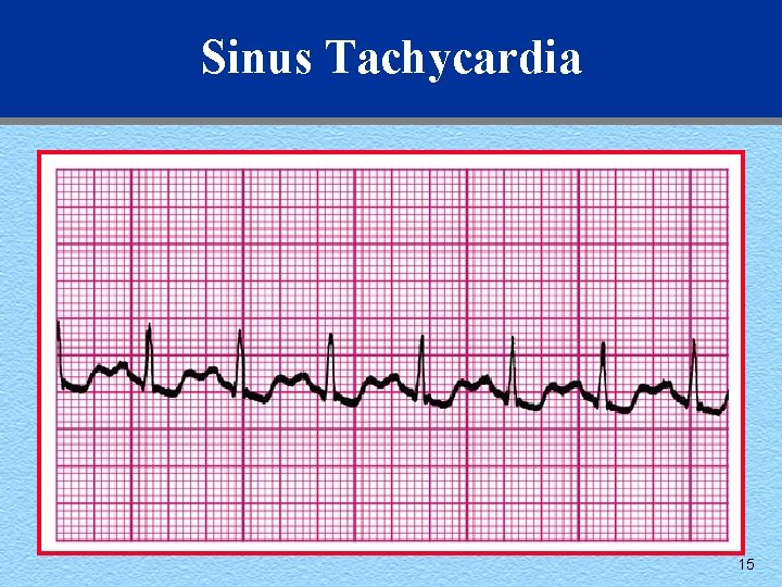 Sinus Tachycardia 15 