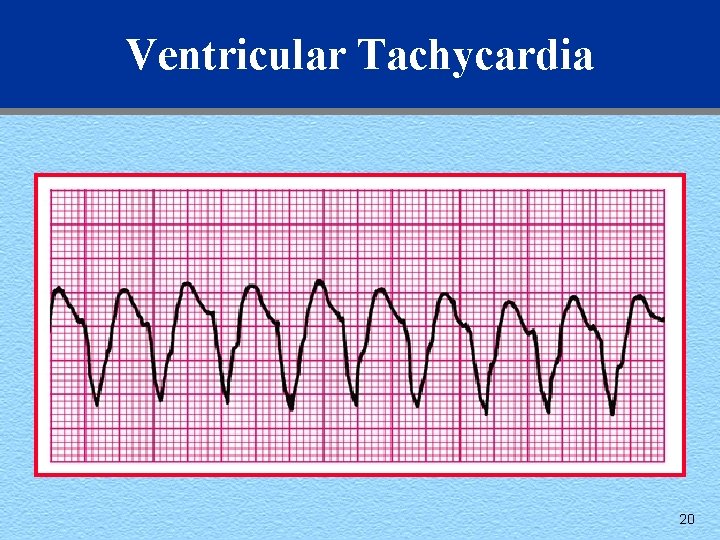 Ventricular Tachycardia 20 