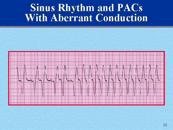 Sinus Rhythm and PACs With Aberrant Conduction 22 