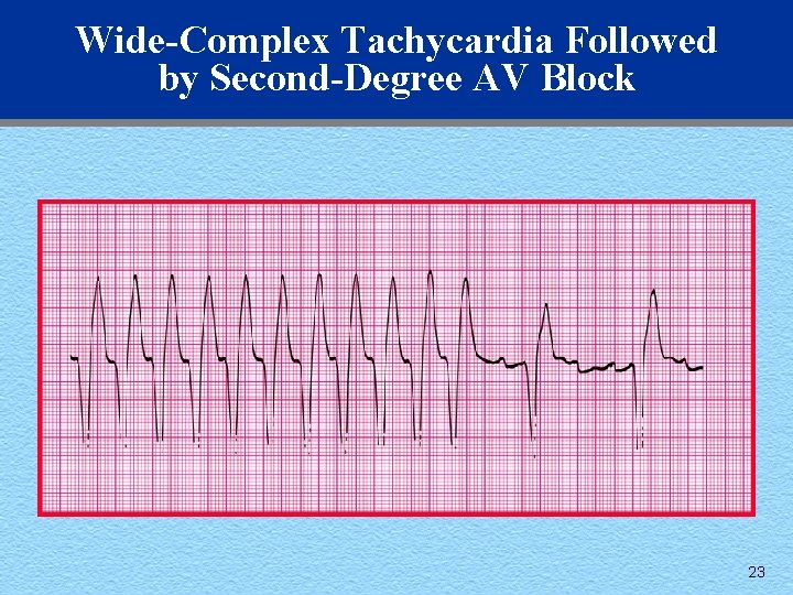 Wide-Complex Tachycardia Followed by Second-Degree AV Block 23 