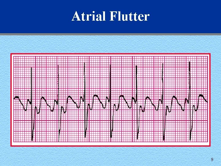 Atrial Flutter 9 