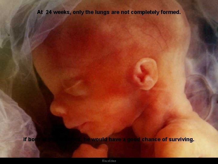 At 24 weeks, only the lungs are not completely formed. if born at this