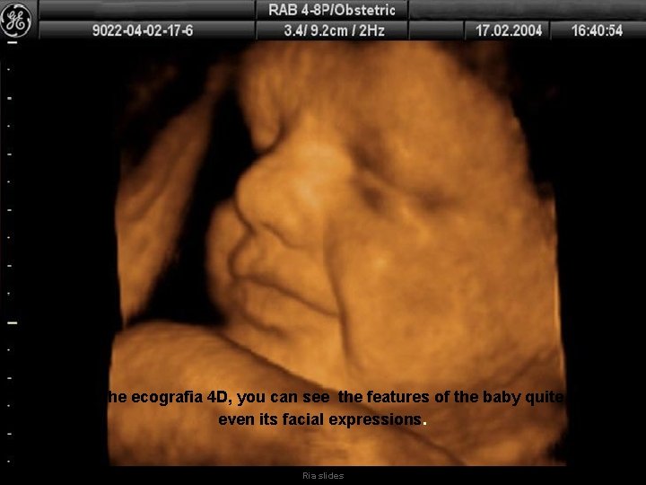 Thanks to the ecografia 4 D, you can see the features of the baby