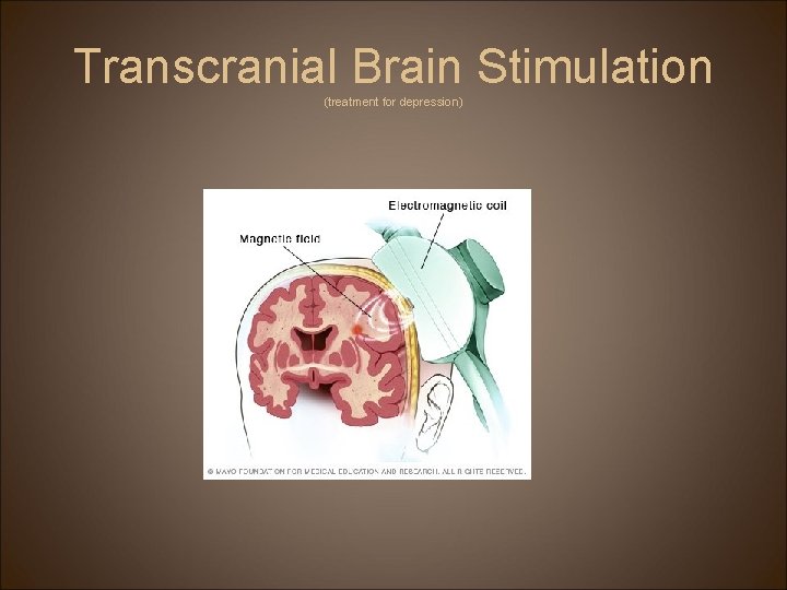 Transcranial Brain Stimulation (treatment for depression) 