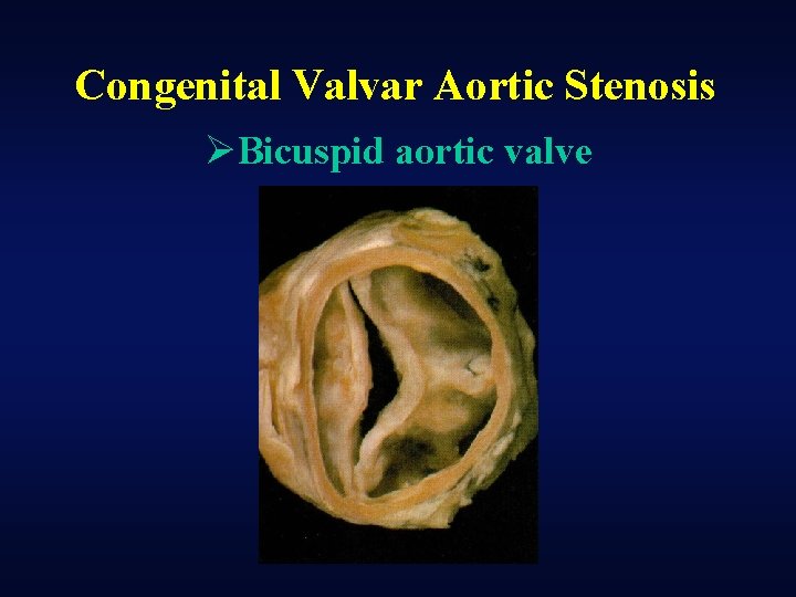 Congenital Valvar Aortic Stenosis ØBicuspid aortic valve 