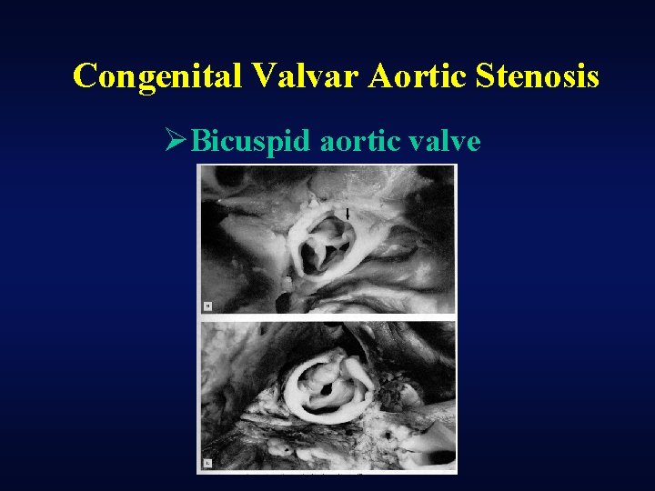 Congenital Valvar Aortic Stenosis ØBicuspid aortic valve 