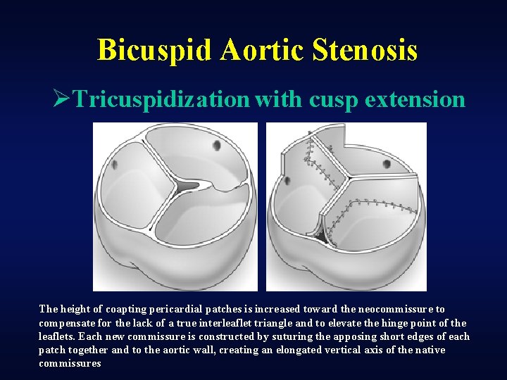 Bicuspid Aortic Stenosis ØTricuspidization with cusp extension The height of coapting pericardial patches is