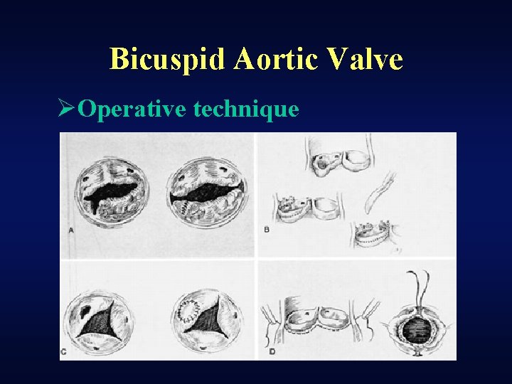 Bicuspid Aortic Valve ØOperative technique 
