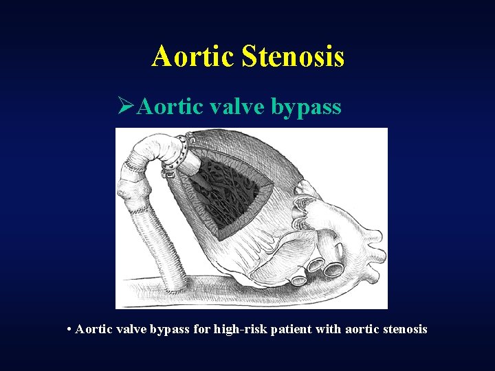 Aortic Stenosis ØAortic valve bypass • Aortic valve bypass for high-risk patient with aortic